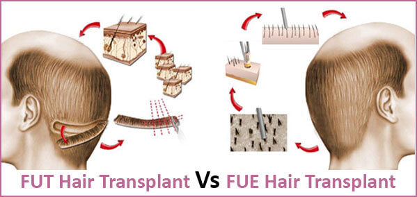 Hair Transplant In Mumbai