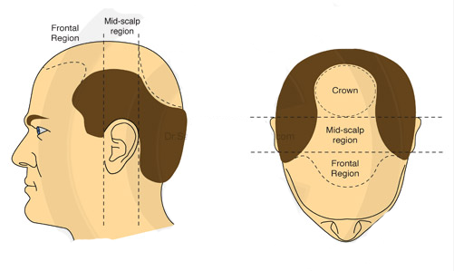 Bald Scalp Regions