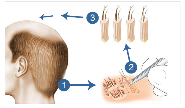 The Process of FUT and FUE