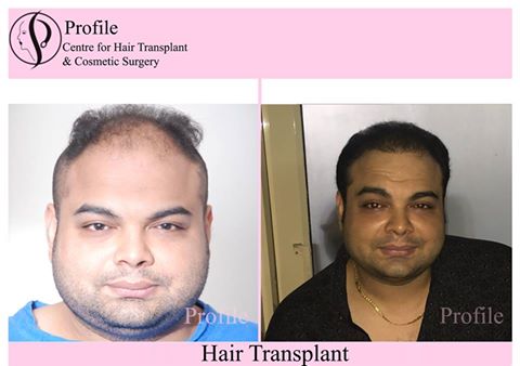 Profile hair transplant