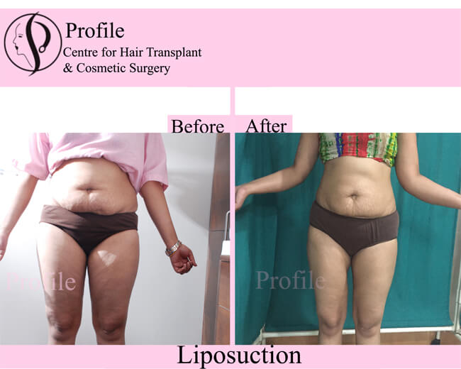 Liposuction Cost in India