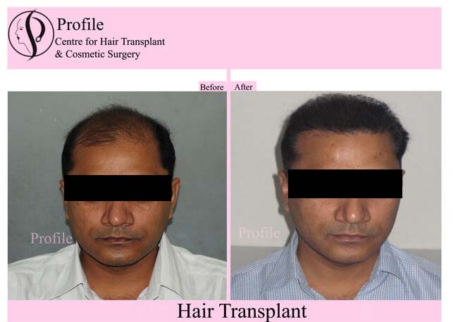 After hair restoration surgery- Discomfort & Pain