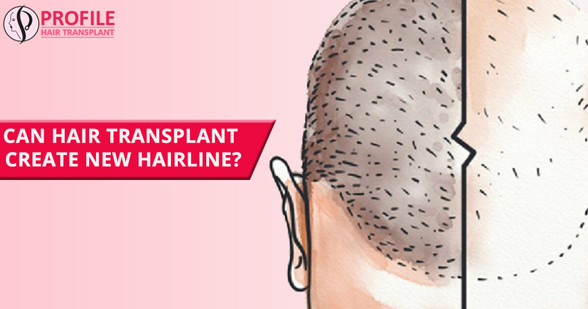 Can Hair Transplant Create New Hairline?