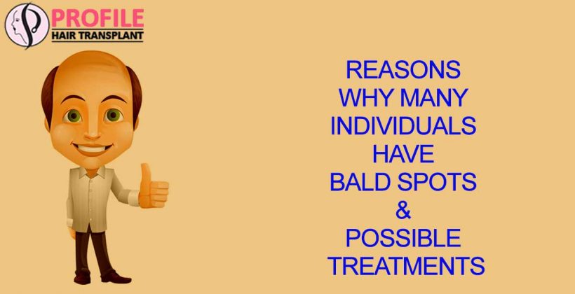 Reasons why many Individuals have bald spots & Possible treatments