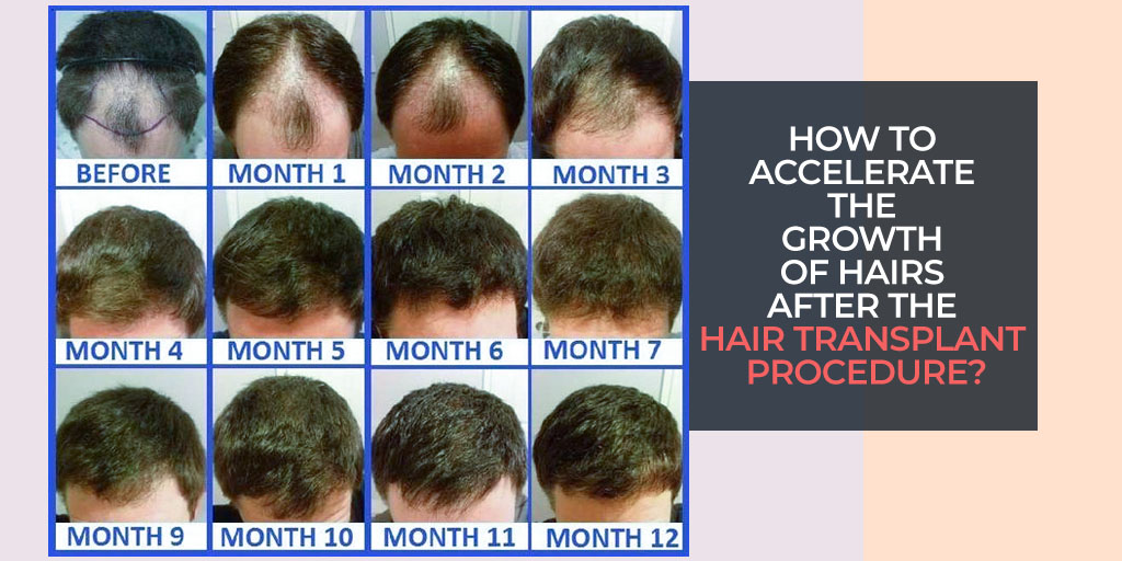 How to accelerate the growth of hairs after the Hair transplant procedure