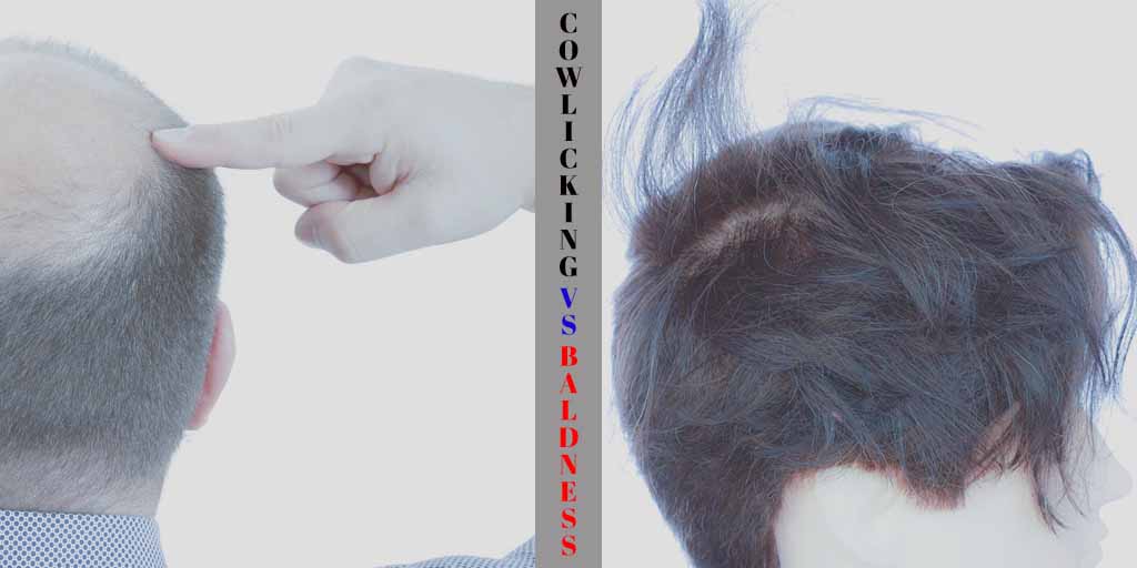 Balding & Cowlicking: What’s the difference & Is there any need to worry?