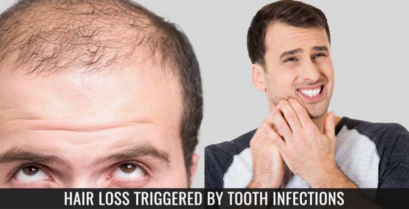 Hair Loss Triggered by Tooth Infections