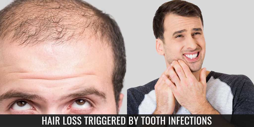 Hair Loss Triggered by Tooth Infections