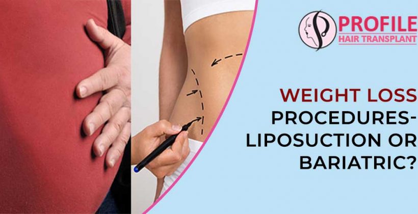 Weight Loss Procedures- Liposuction or Bariatric?