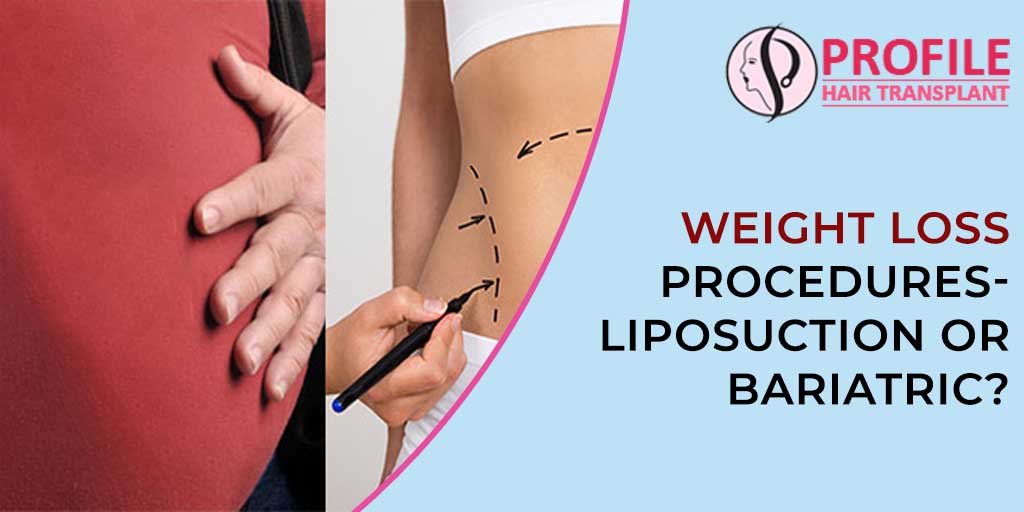Weight Loss Procedures- Liposuction or Bariatric?