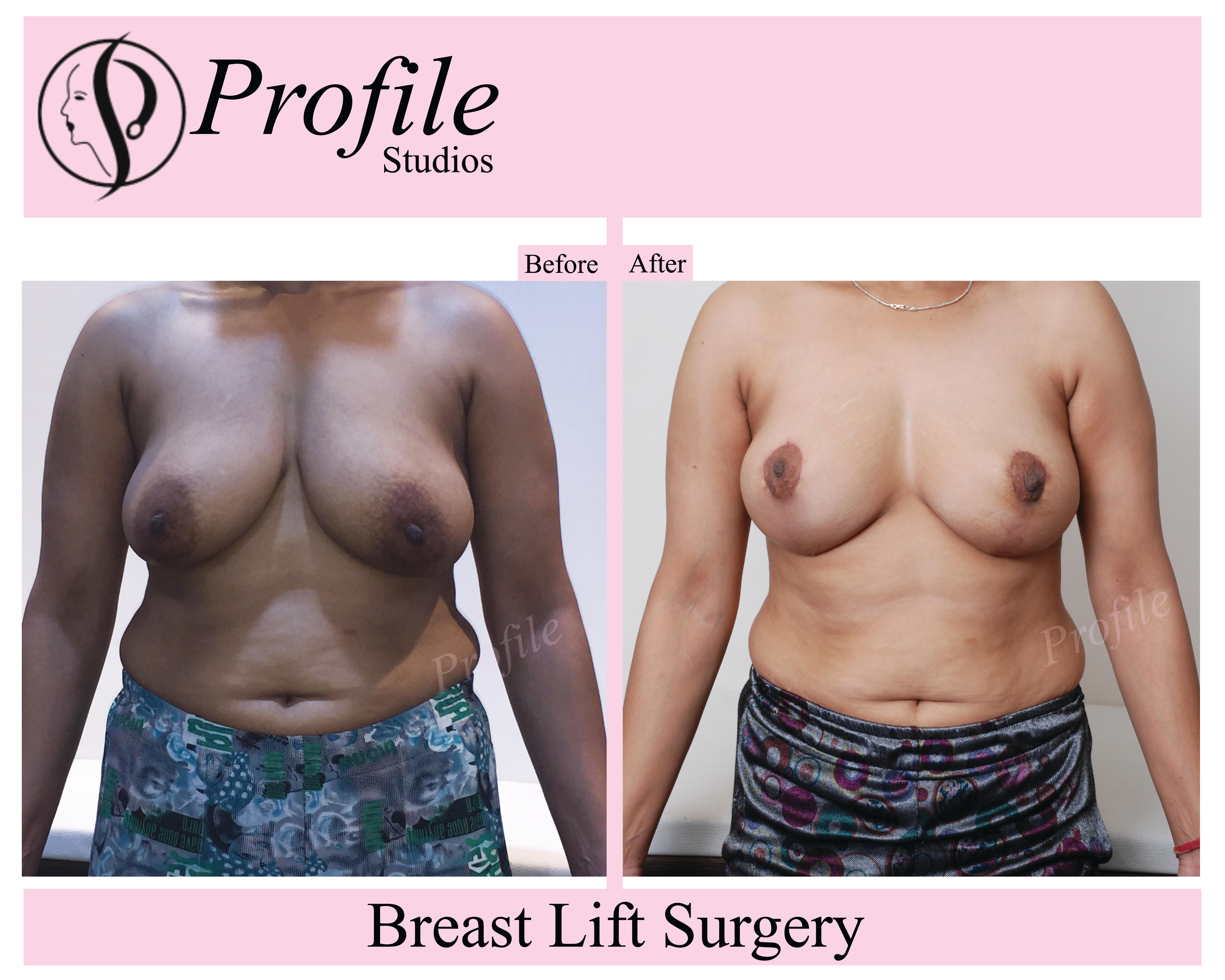 breast lift surgery1