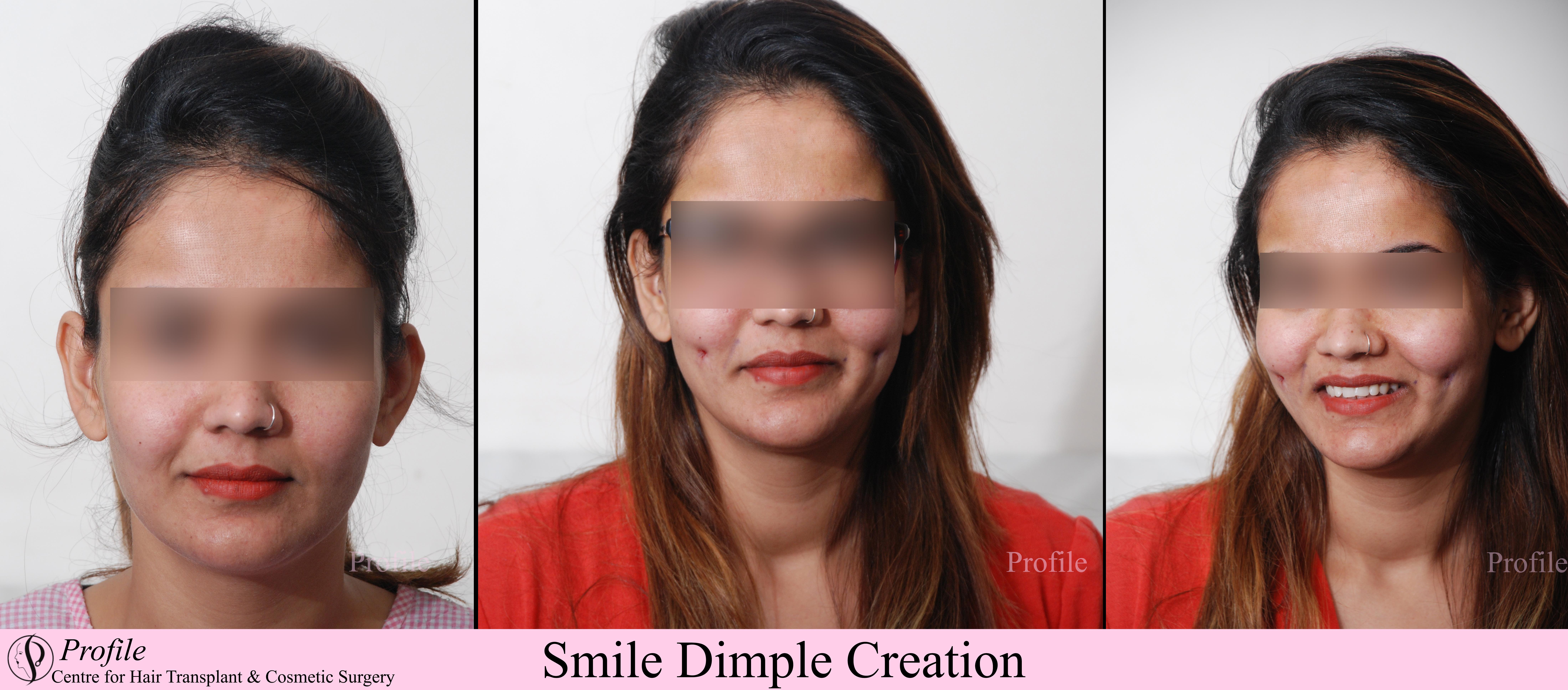 dimple creation1
