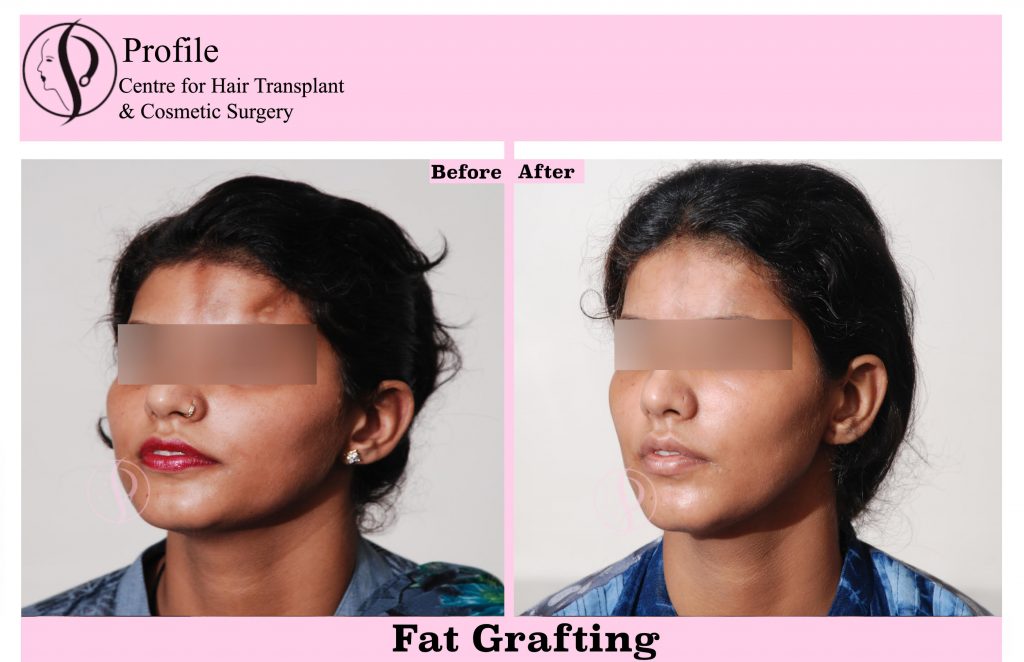 Facial Fat Grafting in India