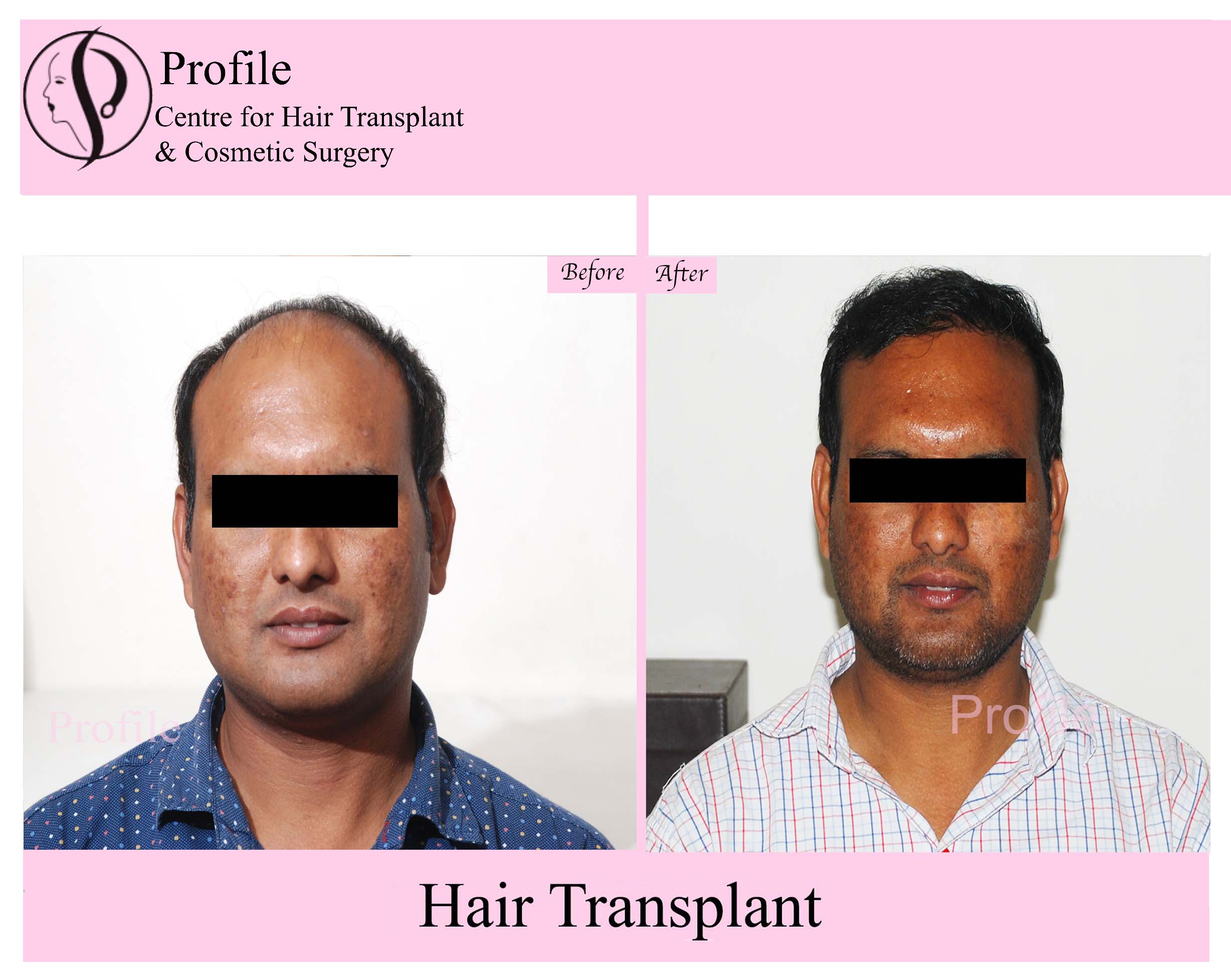 Hair Transplant Results before and after Surgery
