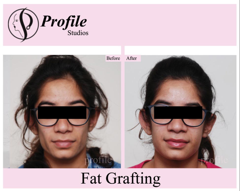 Fat-Grafting