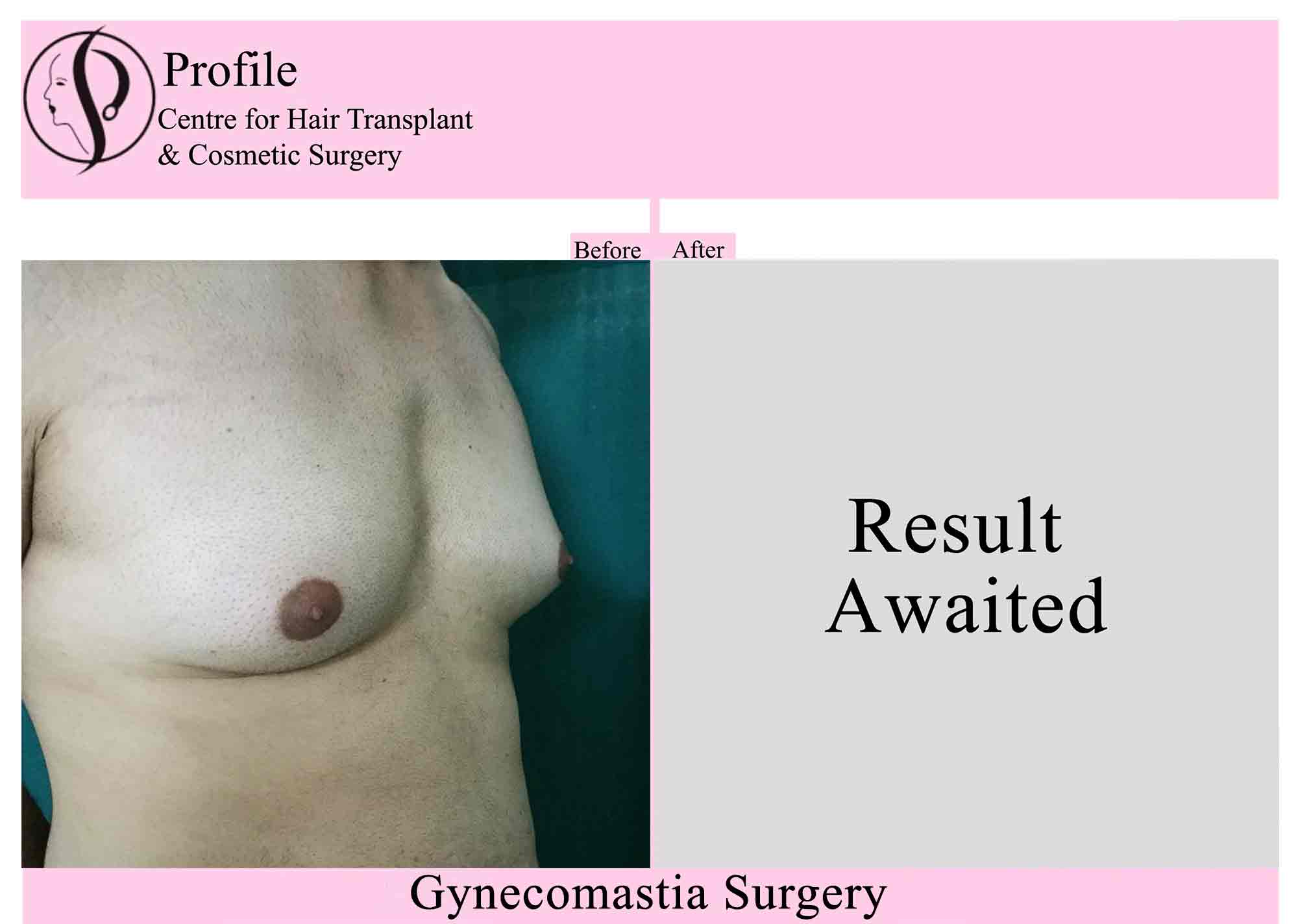 Gynecomastia-Result