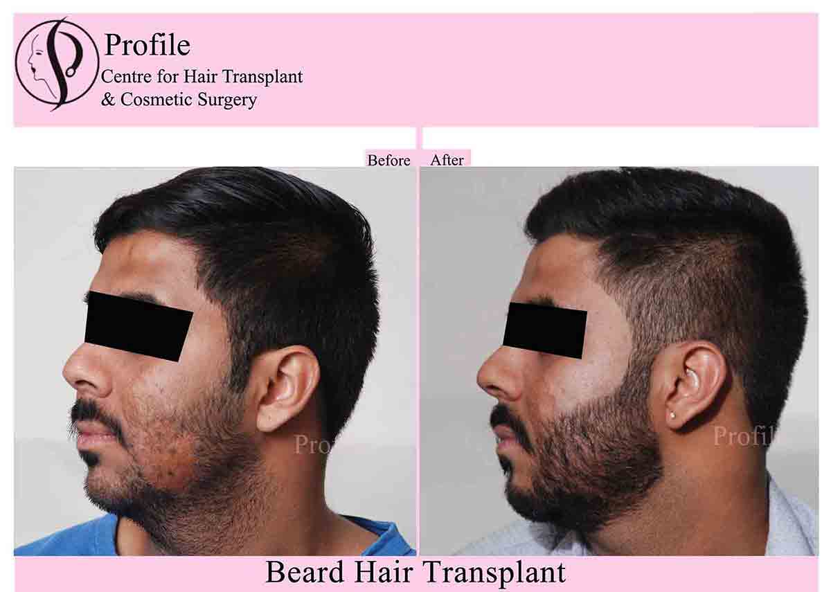 beardd-trans