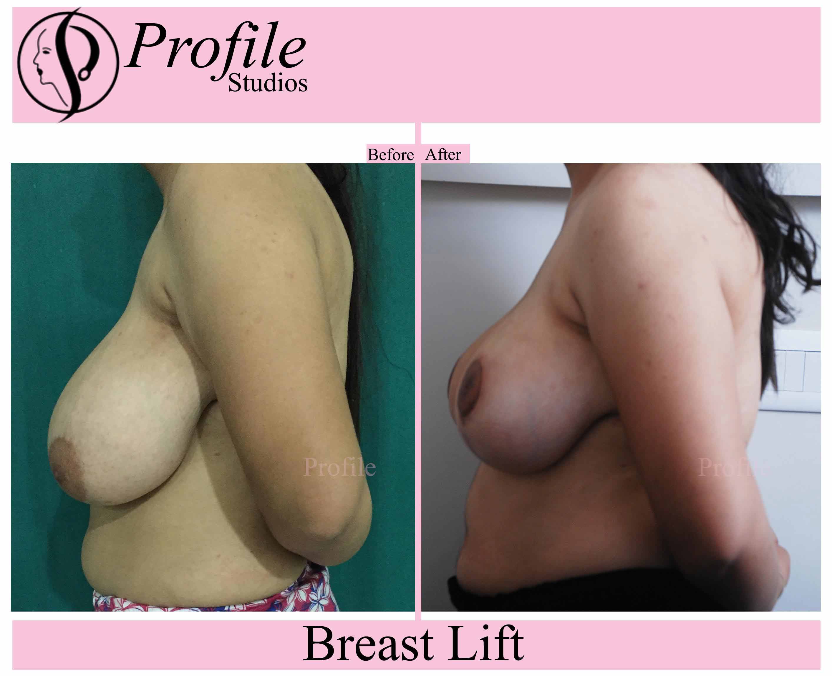 breast-lift-uma