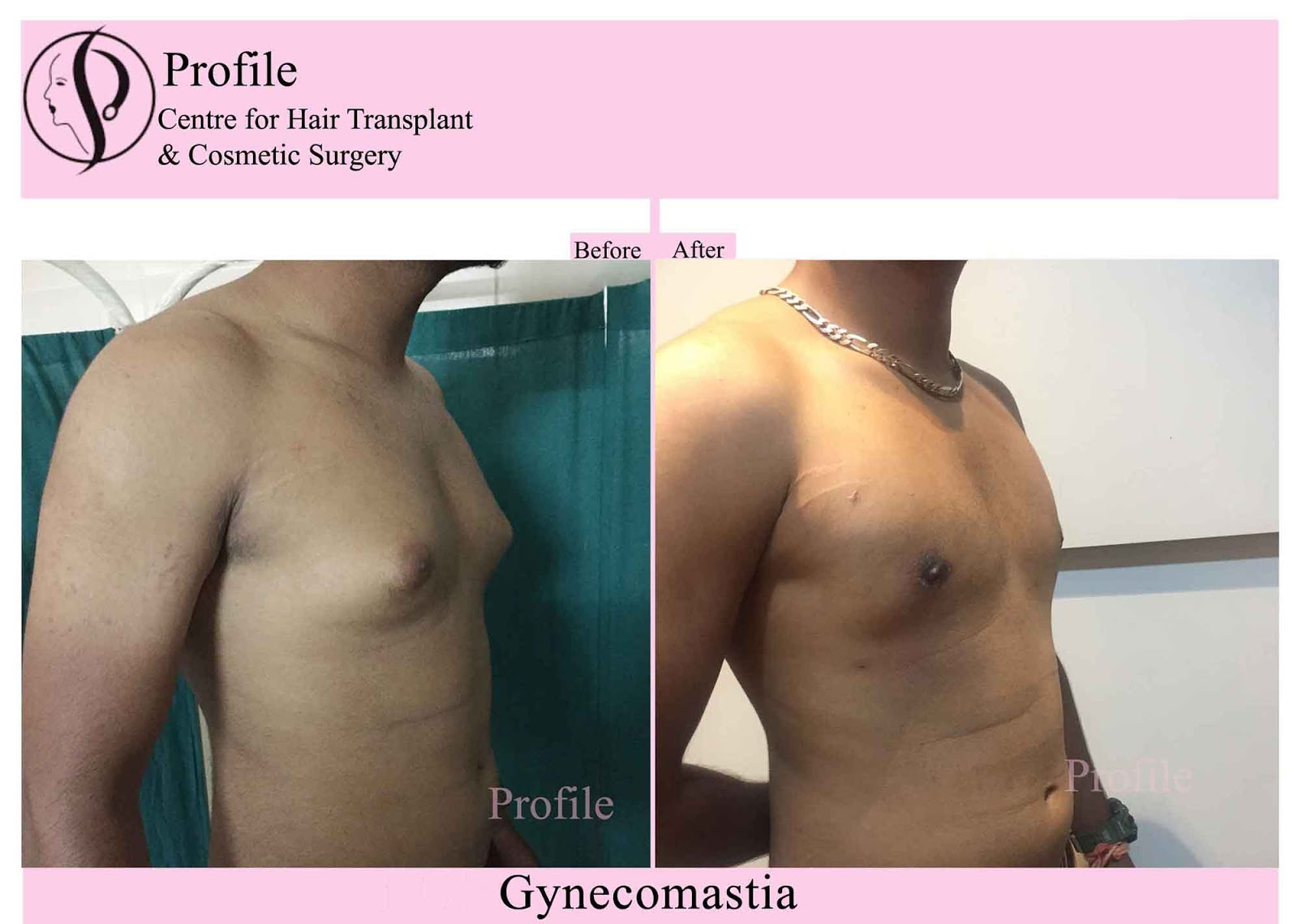 Gynecomatia-Result (1)