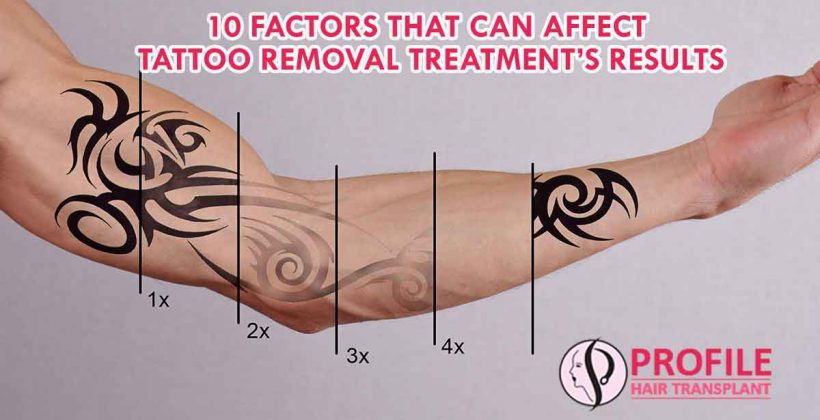 10 Factors That Can Affect Tattoo Removal Treatment’s Results