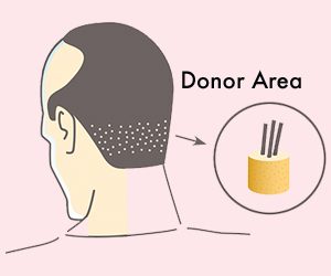 PREPARATION OF DONOR AREA