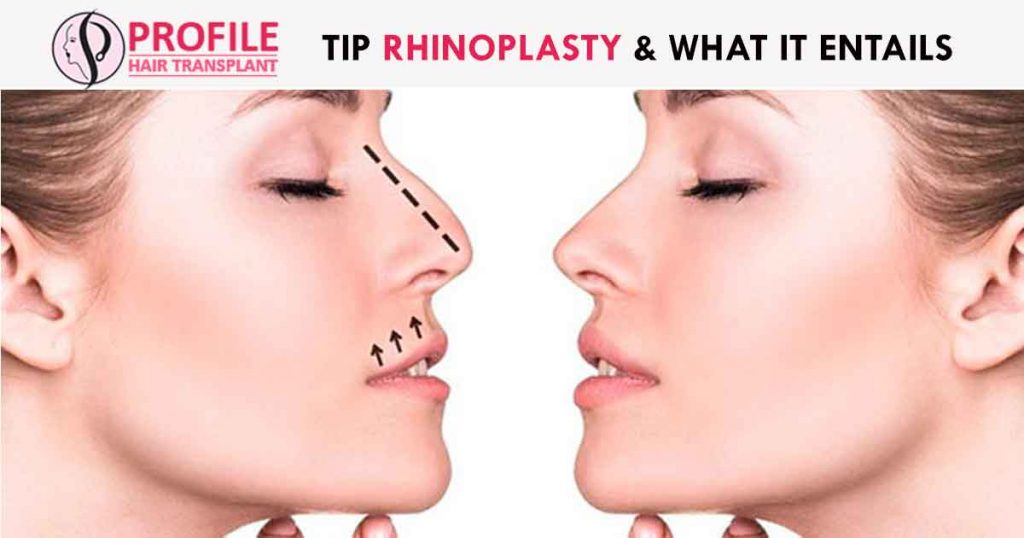 Tip Rhinoplasty & What It Entails 