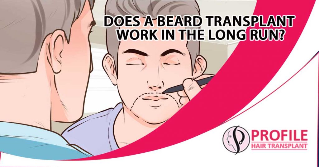 Does a beard transplant work in the long run?