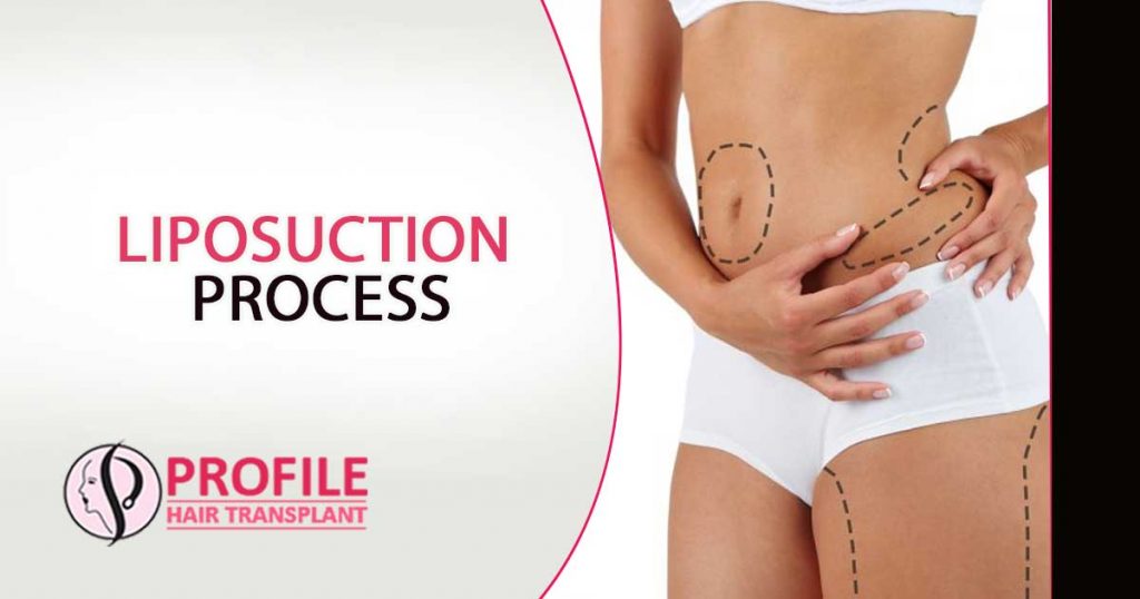 Liposuction process