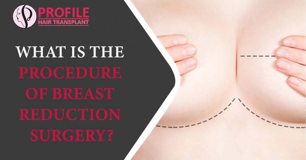 What is the procedure of Breast reduction surgery