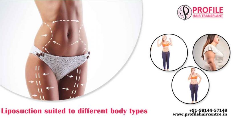 Liposuction Suited To Different Body Types