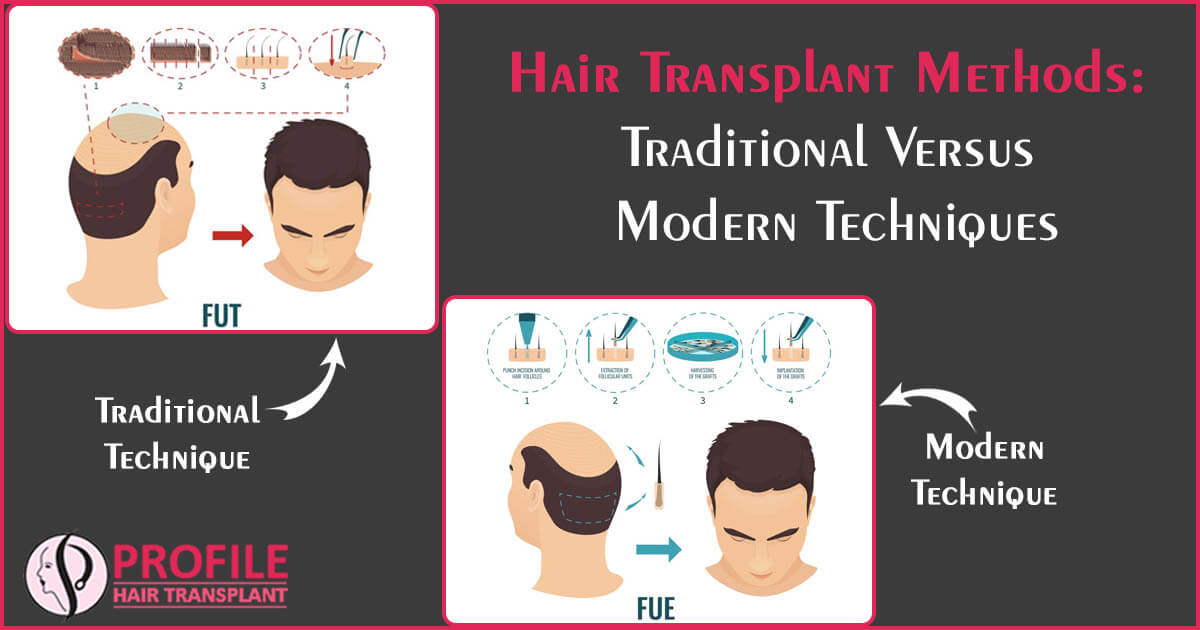 Hair Transplant Methods: Traditional Versus Modern Techniques