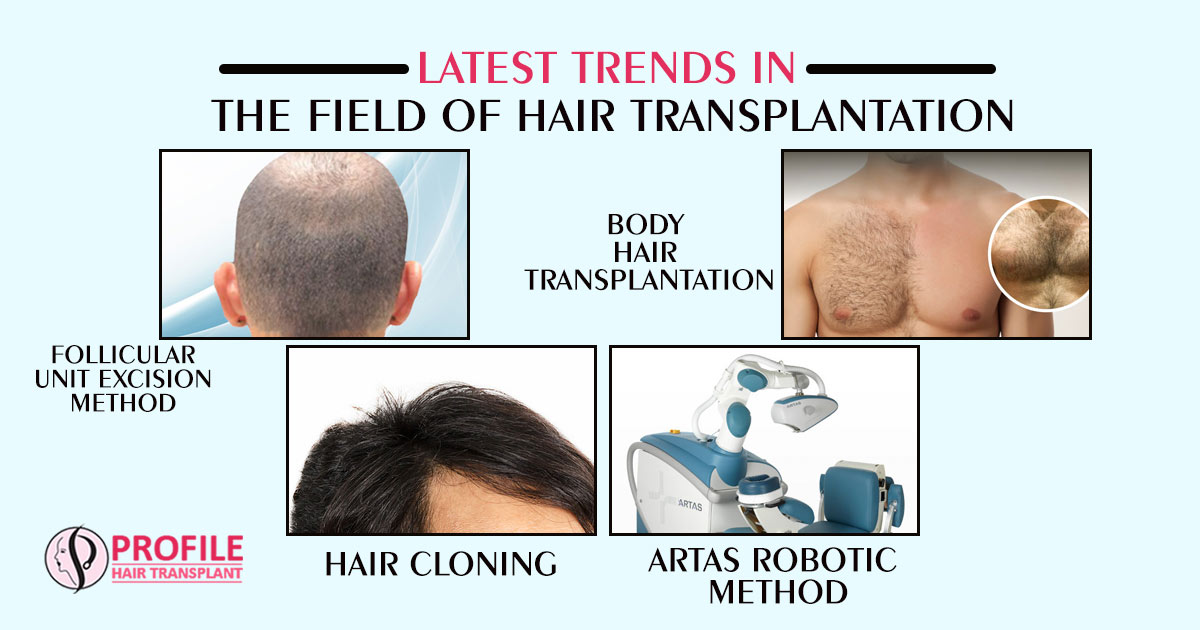 Hair Transplant Cost in Khanna | FUE Hair Transplant in Khanna