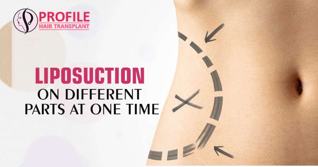 Liposuction surgery in India is generally performed to remove fats from following areas