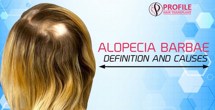 Alopecia Barbae – Definition and Causes