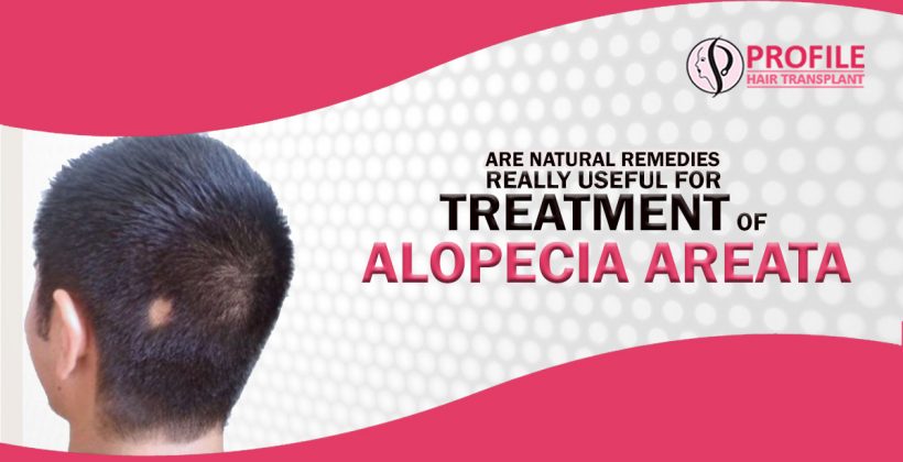 Are Natural Remedies Really Useful for treatment of Alopecia Areata