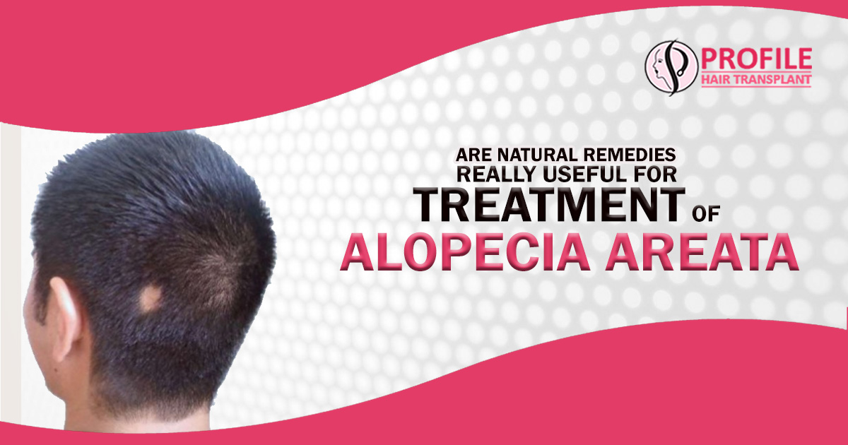 Are Natural Remedies Really Useful for treatment of Alopecia Areata