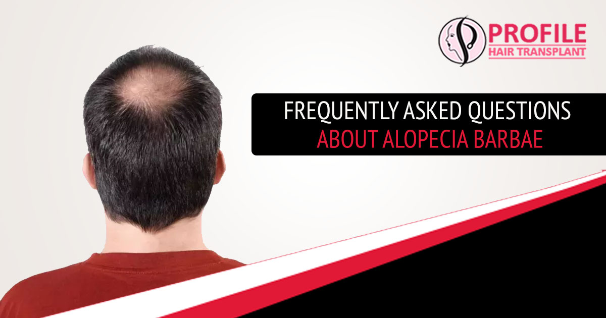 Frequently Asked Questions About Alopecia Barbae