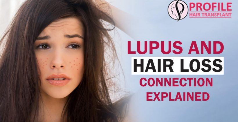 Lupus And Hair Loss – Connection Explained