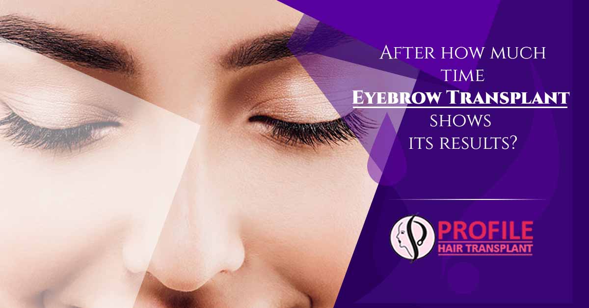 After How Much Time Eyebrow Transplant Shows Its Results?