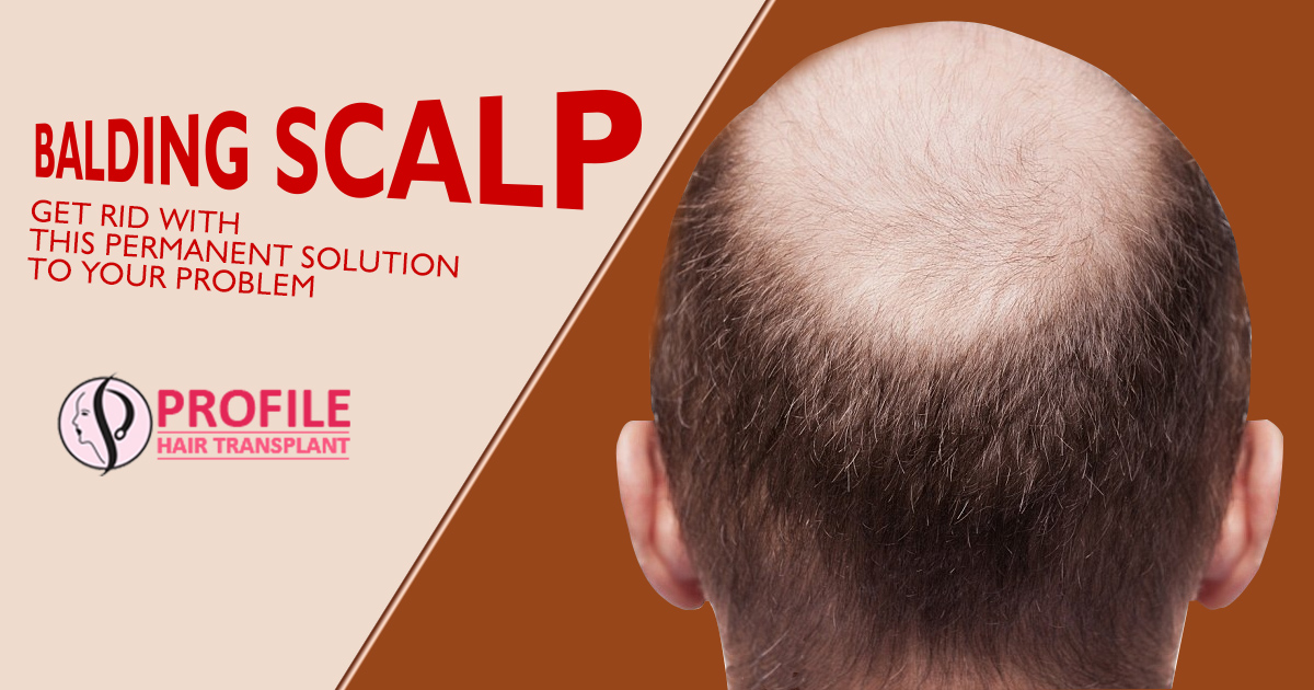 Balding Scalp : Get Rid With This Permanent Solution To Your Problem
