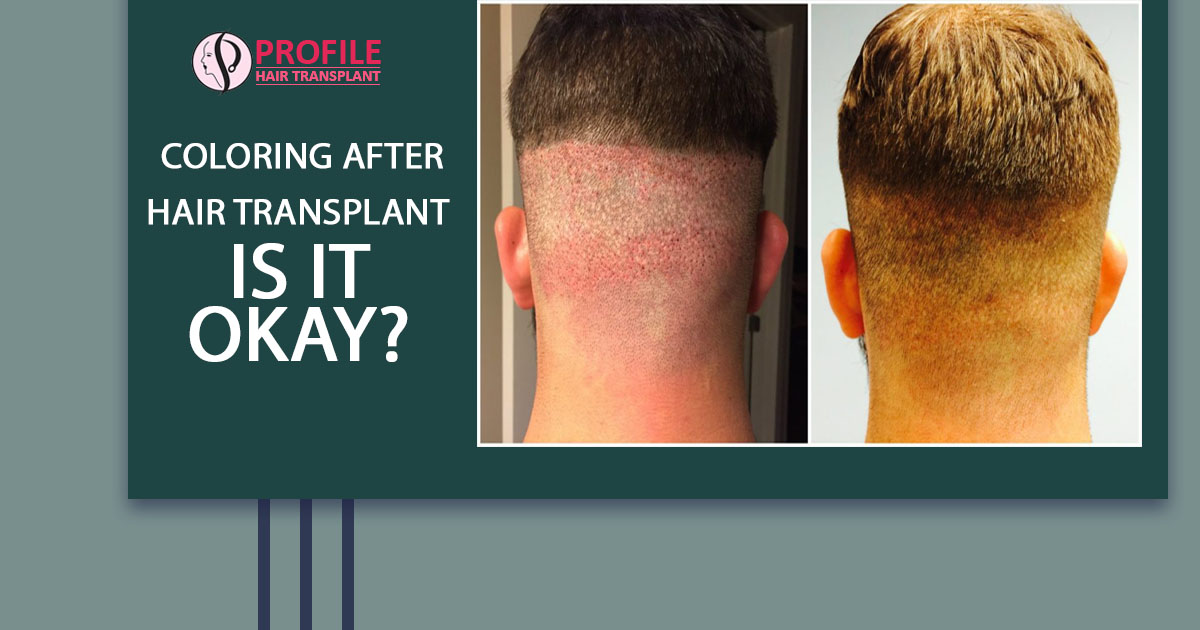 Coloring After Hair Transplant – Is It Okay?
