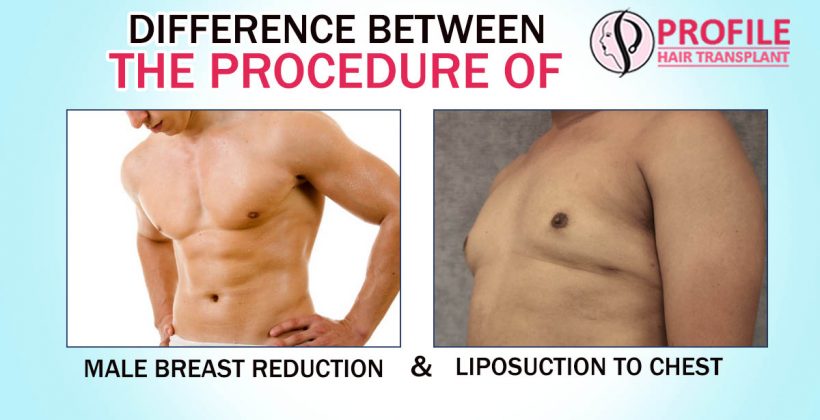 Difference Between The Procedure Of Male Breast Reduction And Liposuction To Chest
