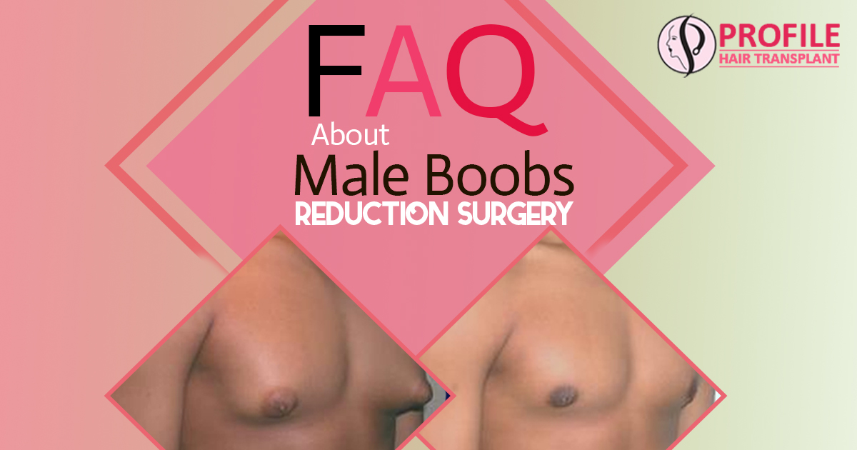 Faq About Male Boobs Reduction Surgery