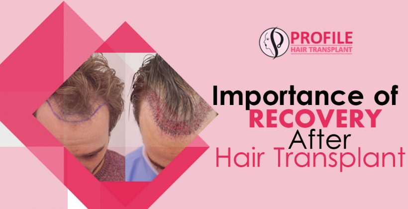Importance of Recovery After Hair Transplant