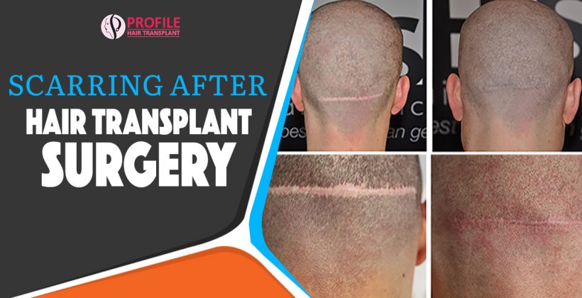 Detailed Information on Scarring After Hair Transplant surgery