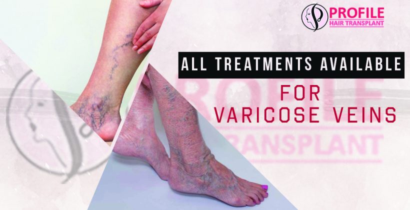 All Treatments Available For Varicose Veins