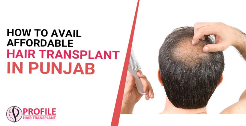 How To Avail Affordable Hair Transplant In Punjab