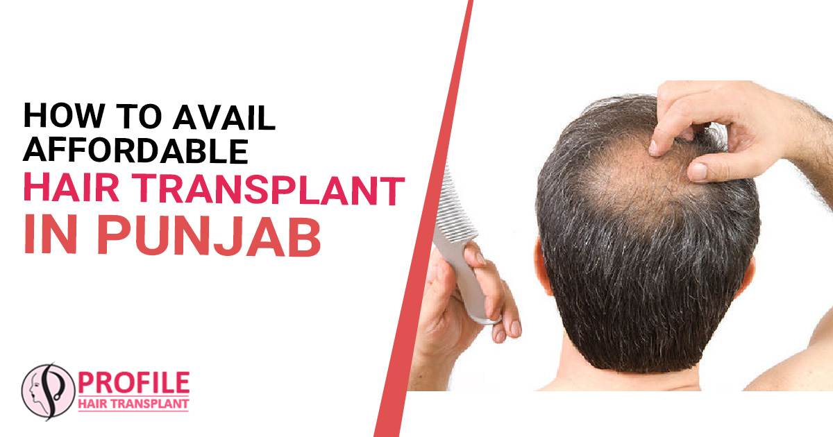 How To Avail Affordable Hair Transplant In Punjab
