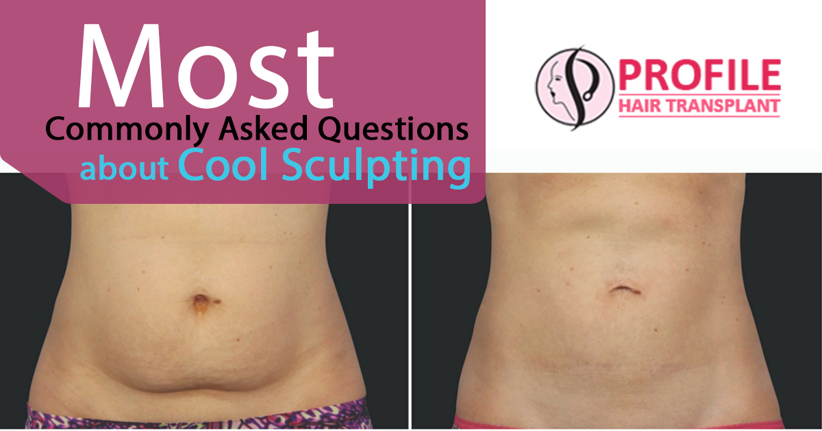 Most Commonly Asked Questions about Cool Sculpting