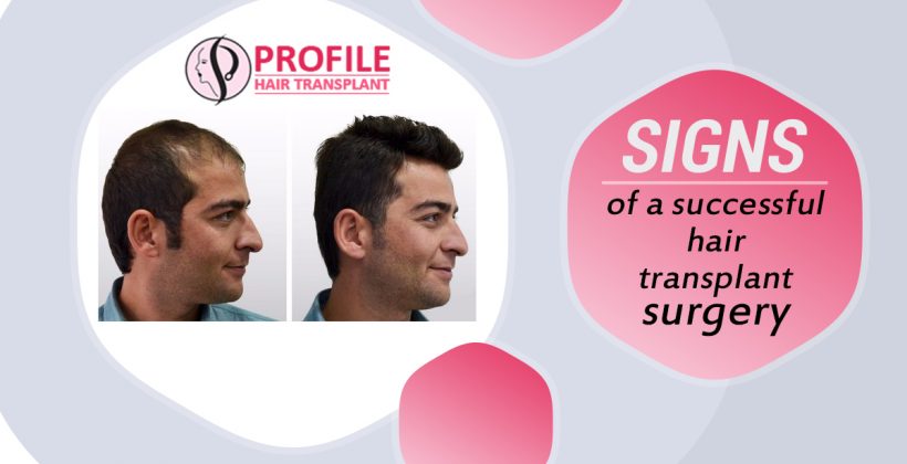 Signs of A Successful Hair Transplant Surgery
